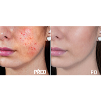 Wellife Kosmetické pero s fotonovou terapií TB-1693