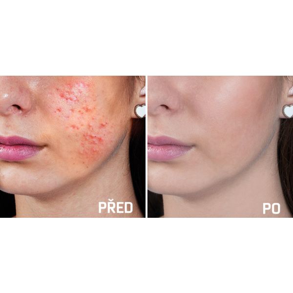 Wellife Kosmetické pero s fotonovou terapií TB-1693